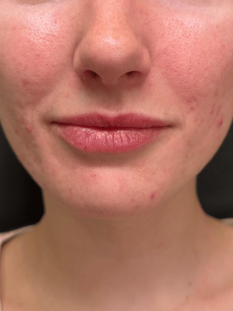 Filler Before & After Gallery - Patient 413399 - Image 1