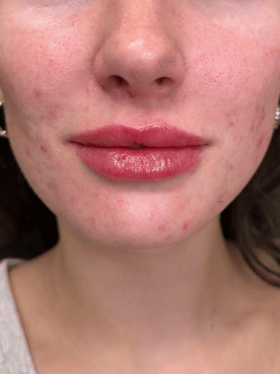 Filler Before & After Gallery - Patient 413399 - Image 2