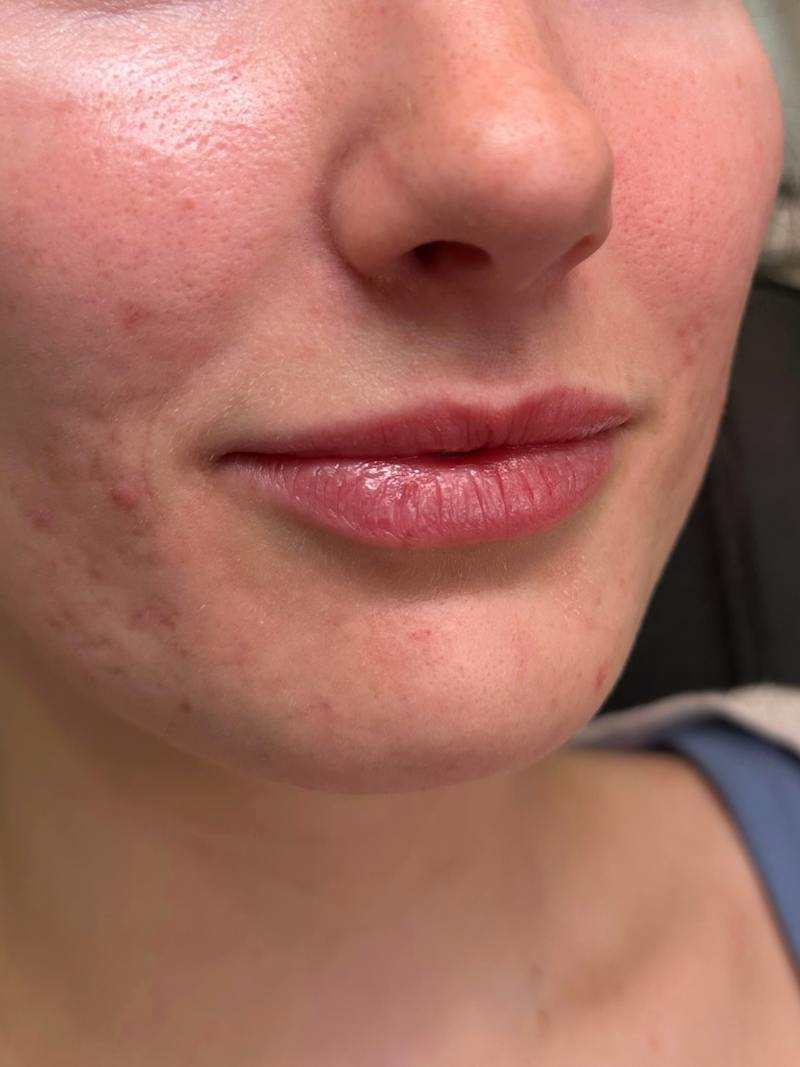 Filler Before & After Gallery - Patient 413399 - Image 3