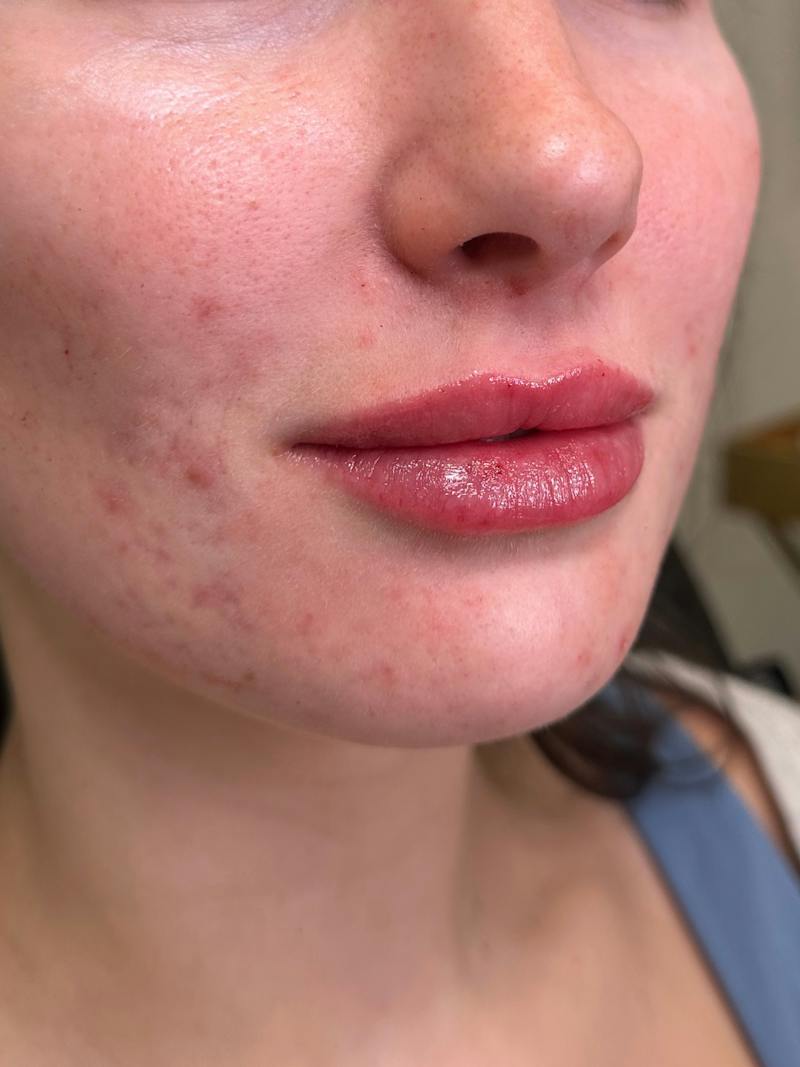 Filler Before & After Gallery - Patient 413399 - Image 4