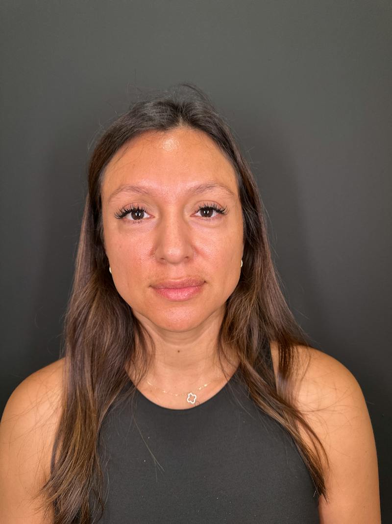 Filler Before & After Gallery - Patient 250650 - Image 1