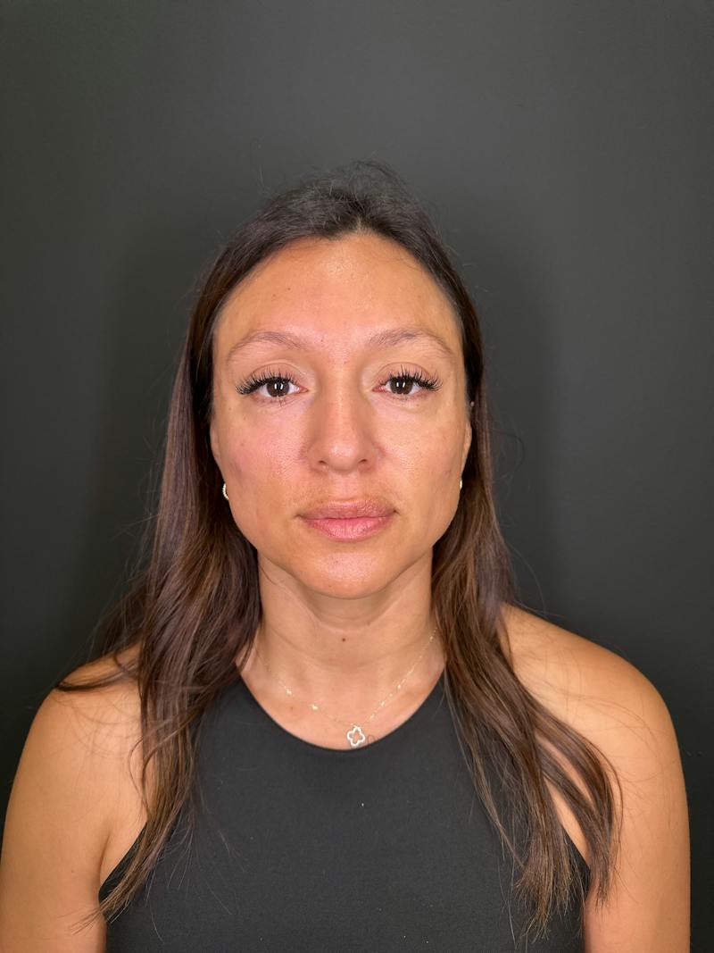 Filler Before & After Gallery - Patient 250650 - Image 2