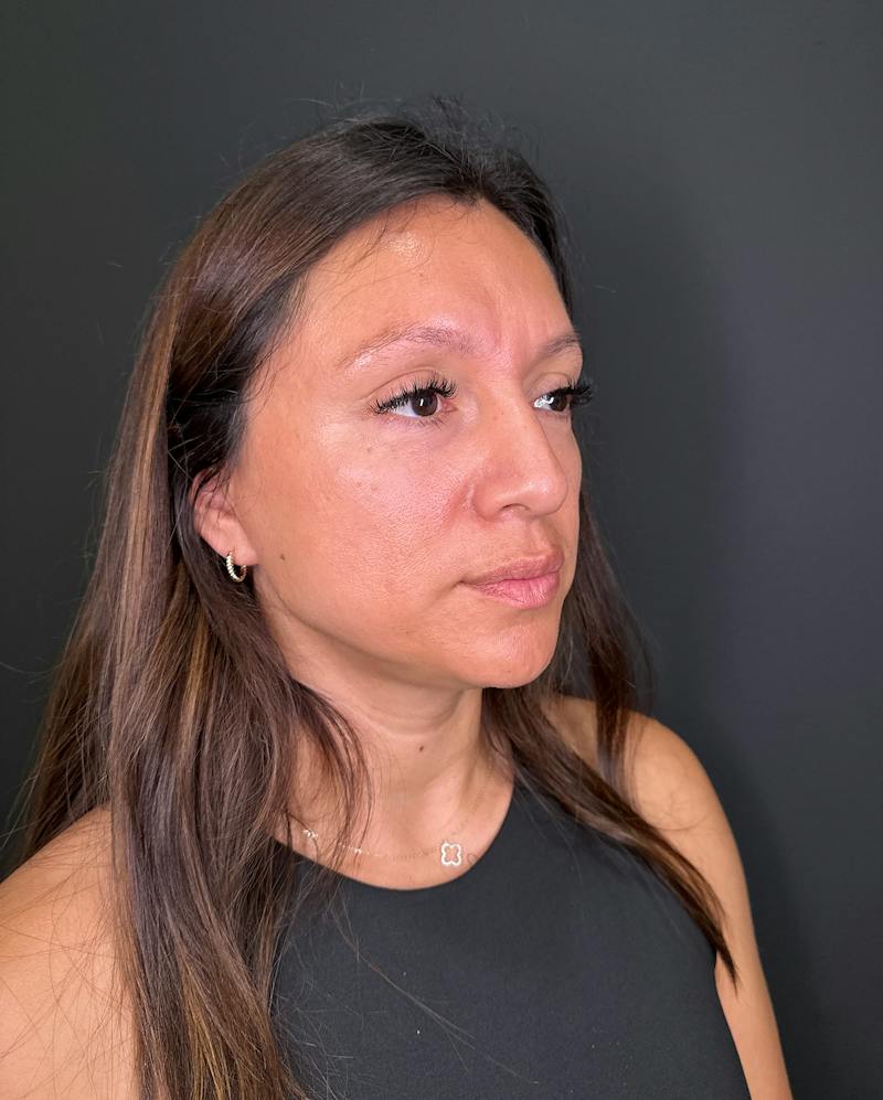Filler Before & After Gallery - Patient 250650 - Image 3