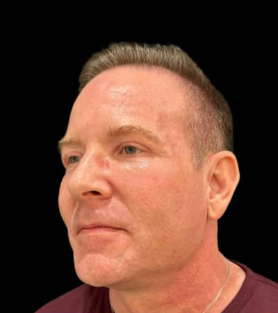 Filler Before & After Gallery - Patient 291155 - Image 1