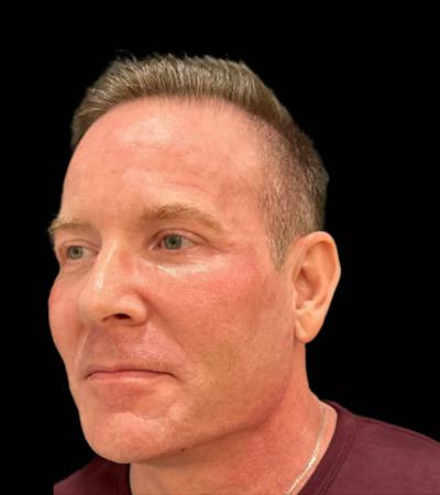 Filler Before & After Gallery - Patient 291155 - Image 2