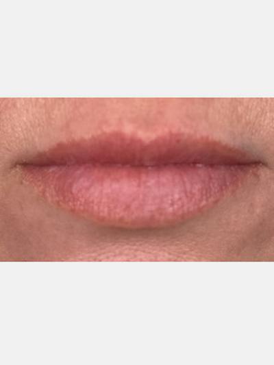 Filler Before & After Gallery - Patient 283218 - Image 1
