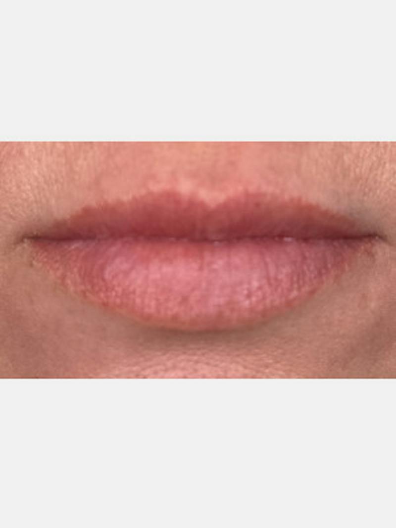 Filler Before & After Gallery - Patient 283218 - Image 1