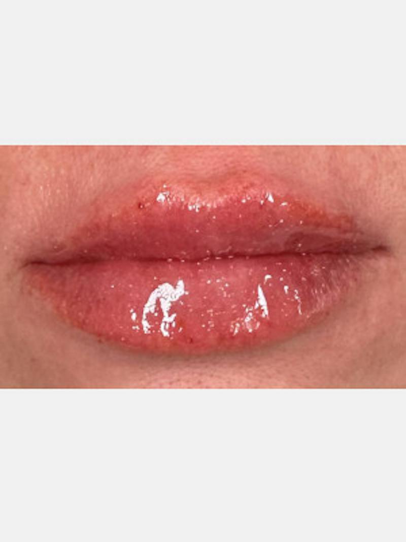 Filler Before & After Gallery - Patient 283218 - Image 2