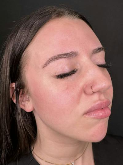 Filler Before & After Gallery - Patient 114647 - Image 1