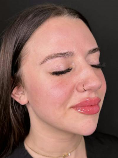 Filler Before & After Gallery - Patient 114647 - Image 2