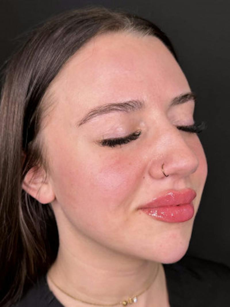 Filler Before & After Gallery - Patient 114647 - Image 2