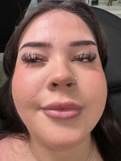 Filler Before & After Gallery - Patient 328342 - Image 1
