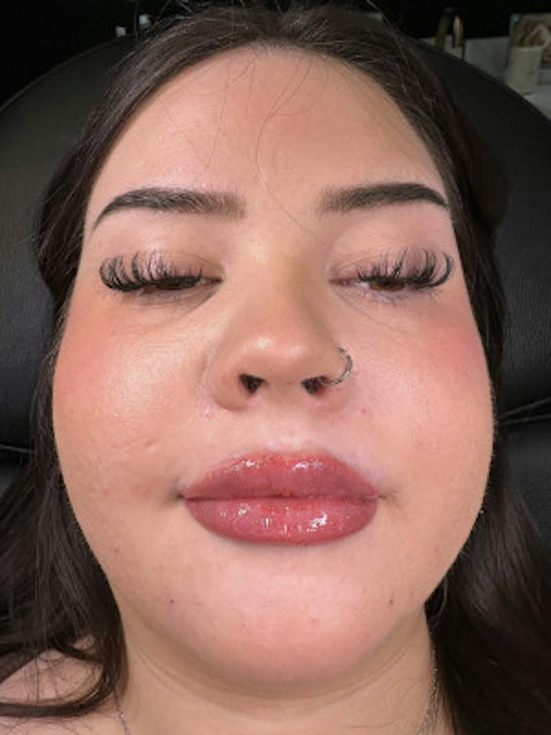 Filler Before & After Gallery - Patient 328342 - Image 2