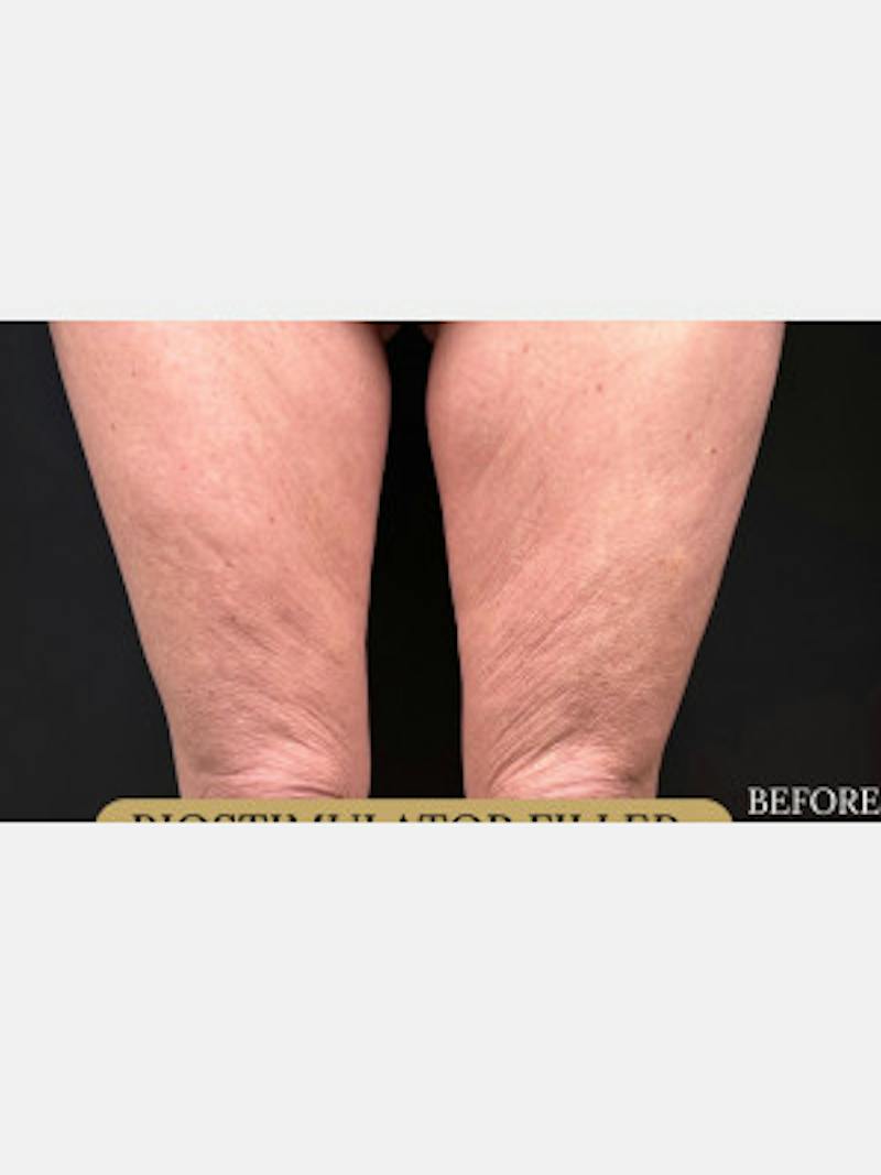 Filler Before & After Gallery - Patient 736984 - Image 1