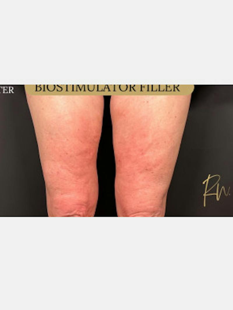 Filler Before & After Gallery - Patient 736984 - Image 2