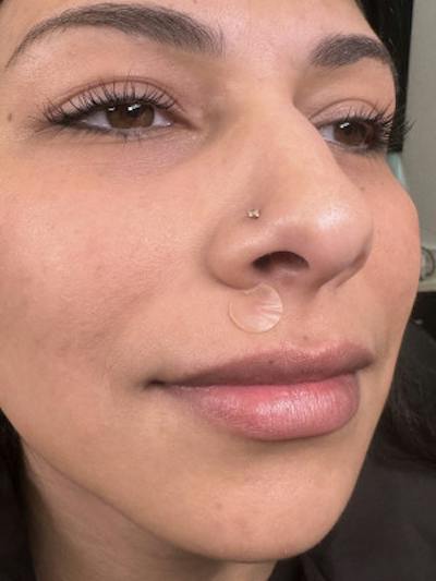 Filler Before & After Gallery - Patient 217263 - Image 1