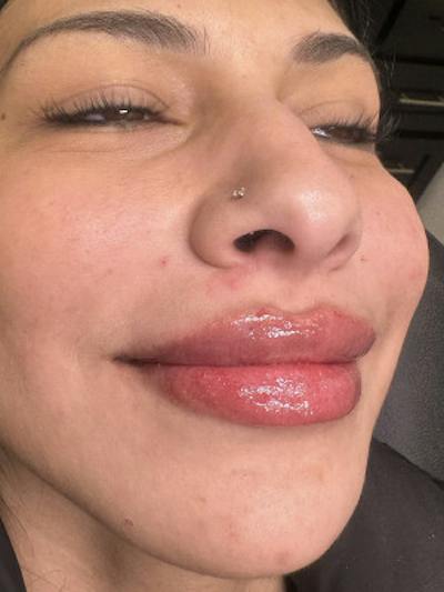 Filler Before & After Gallery - Patient 217263 - Image 2