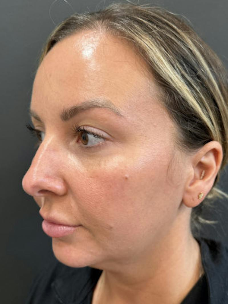Filler Before & After Gallery - Patient 370406 - Image 1