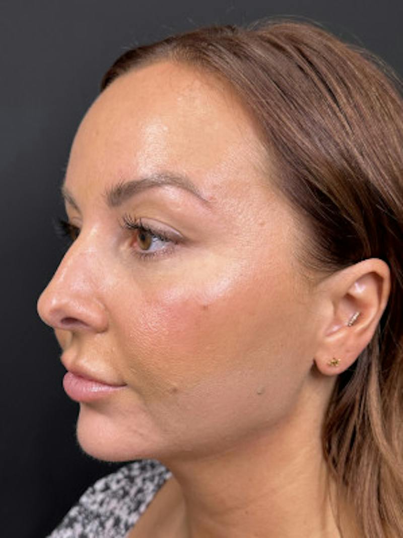 Filler Before & After Gallery - Patient 370406 - Image 2