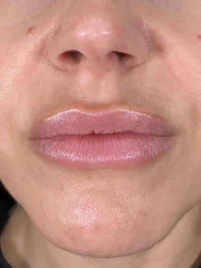 Filler Before & After Gallery - Patient 111005 - Image 1