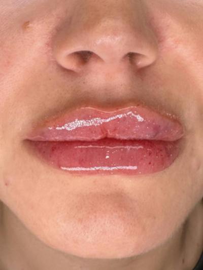 Filler Before & After Gallery - Patient 111005 - Image 2