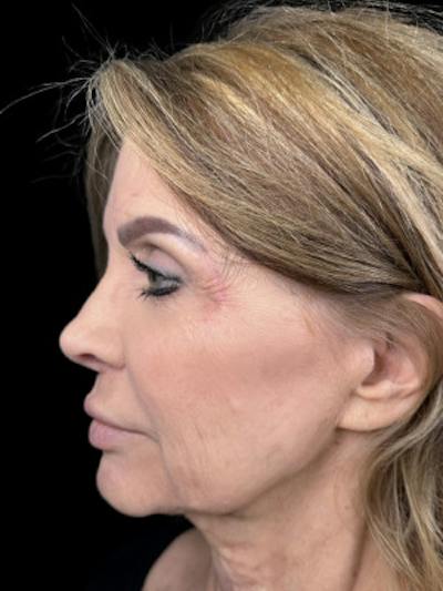 Filler Before & After Gallery - Patient 214512 - Image 1