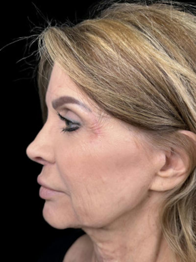 Filler Before & After Gallery - Patient 214512 - Image 1