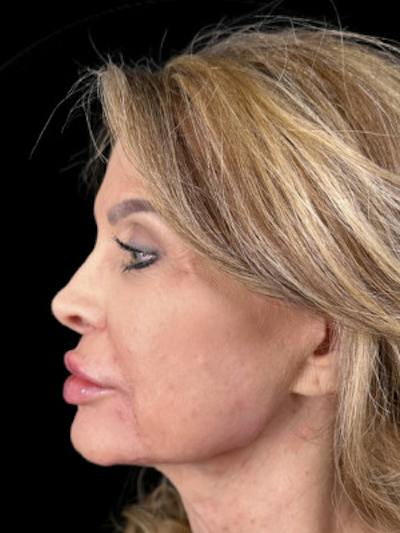 Filler Before & After Gallery - Patient 214512 - Image 2