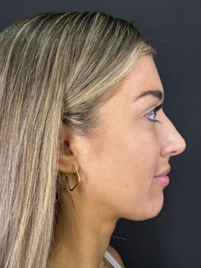Filler Before & After Gallery - Patient 401255 - Image 1