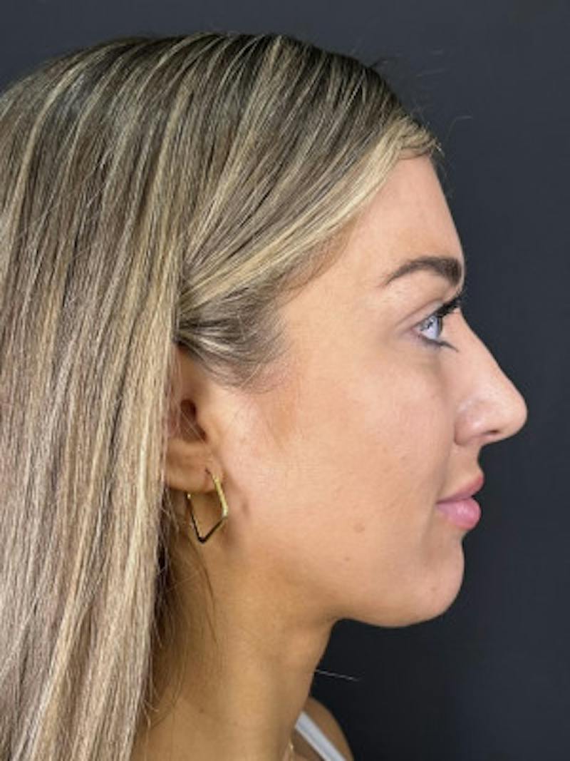 Filler Before & After Gallery - Patient 401255 - Image 1