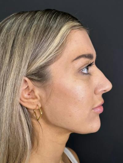 Filler Before & After Gallery - Patient 401255 - Image 2