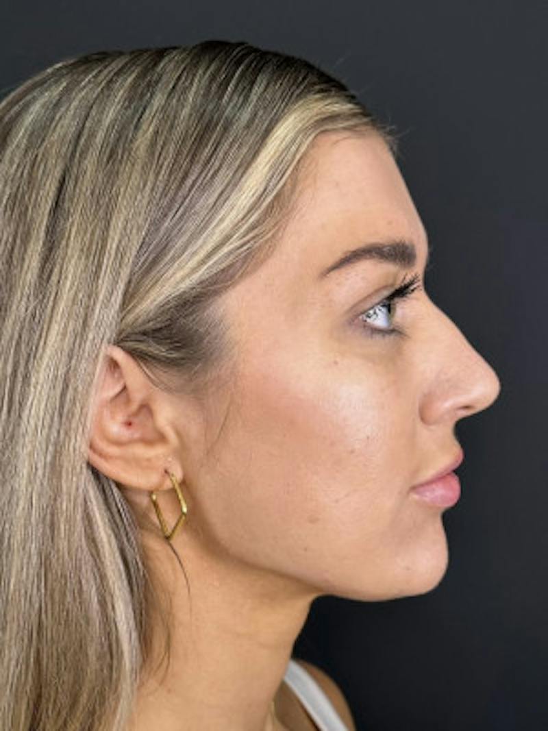 Filler Before & After Gallery - Patient 401255 - Image 2