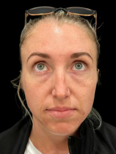 Filler Before & After Gallery - Patient 114457 - Image 1