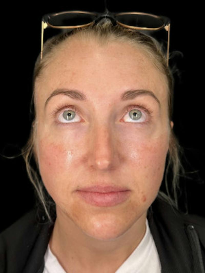Filler Before & After Gallery - Patient 114457 - Image 2
