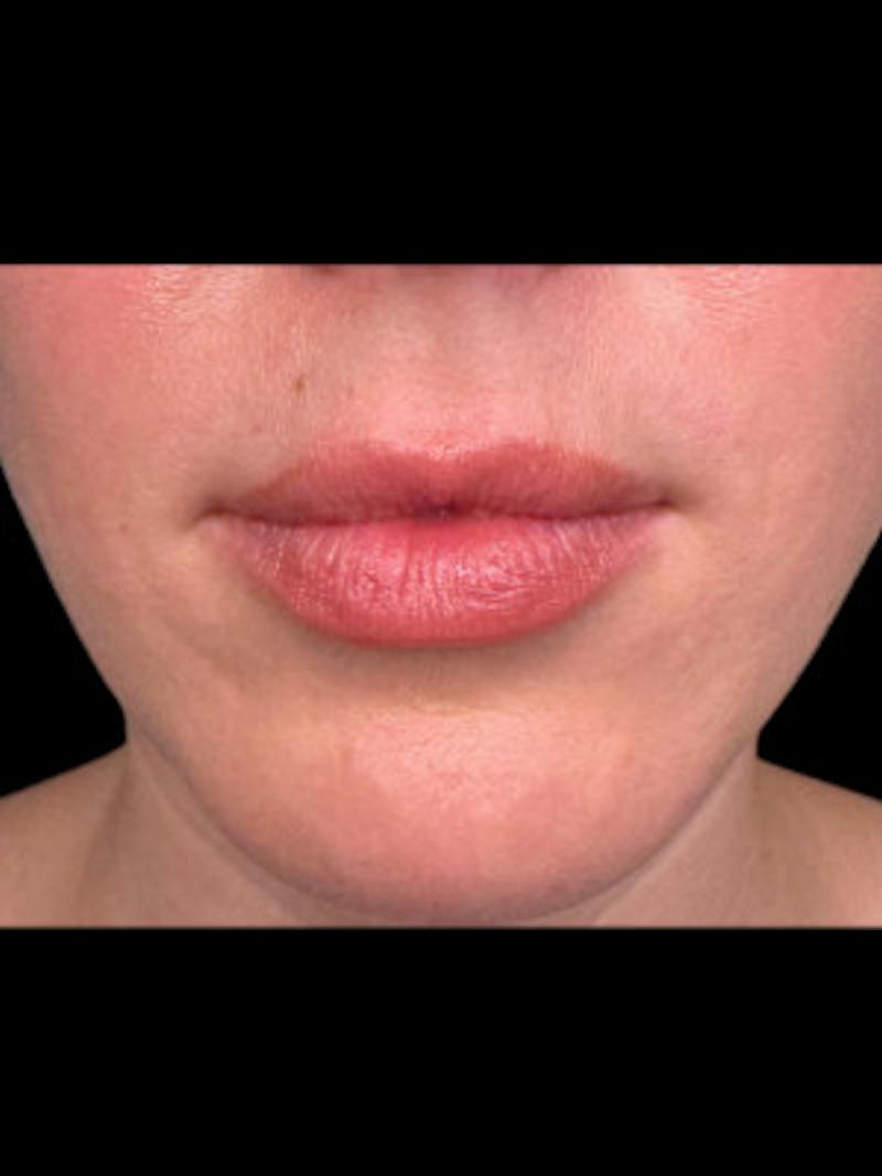Filler Before & After Gallery - Patient 143213 - Image 1