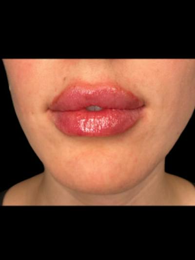 Filler Before & After Gallery - Patient 143213 - Image 2