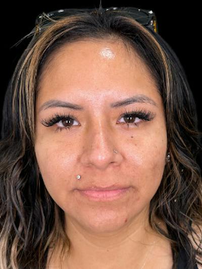 Filler Before & After Gallery - Patient 220733 - Image 1