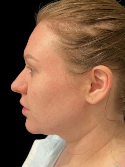 Filler Before & After Gallery - Patient 325518 - Image 1