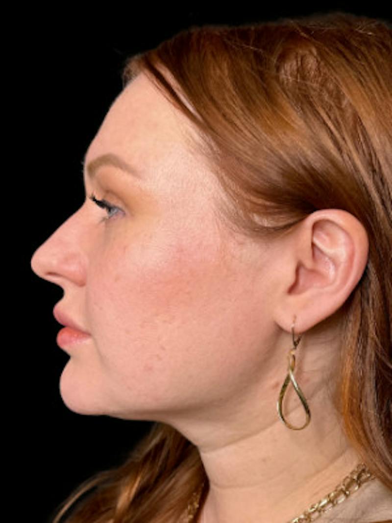 Filler Before & After Gallery - Patient 325518 - Image 2