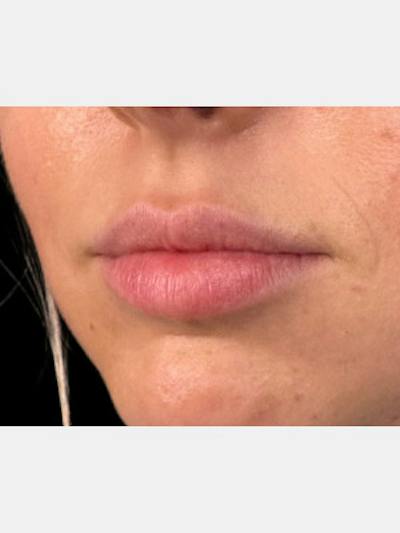 Filler Before & After Gallery - Patient 111570 - Image 1