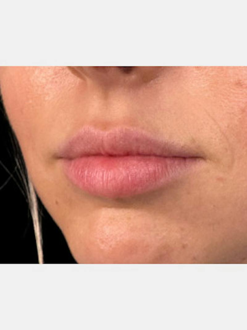 Filler Before & After Gallery - Patient 111570 - Image 1