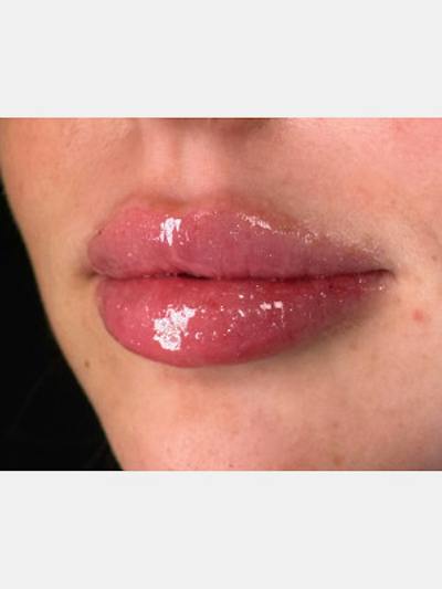 Filler Before & After Gallery - Patient 111570 - Image 2