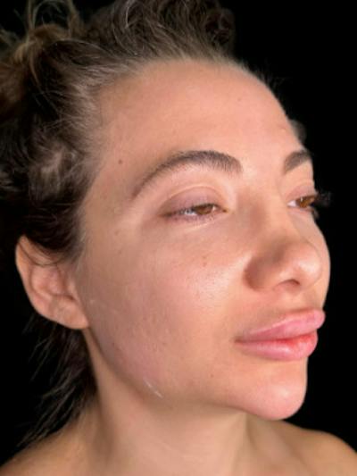 Filler Before & After Gallery - Patient 299646 - Image 1