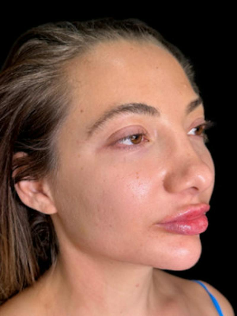Filler Before & After Gallery - Patient 299646 - Image 2
