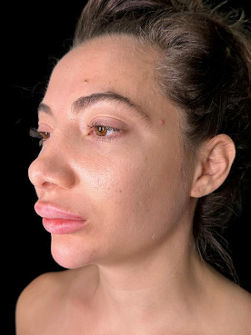 Filler Before & After Gallery - Patient 299646 - Image 3