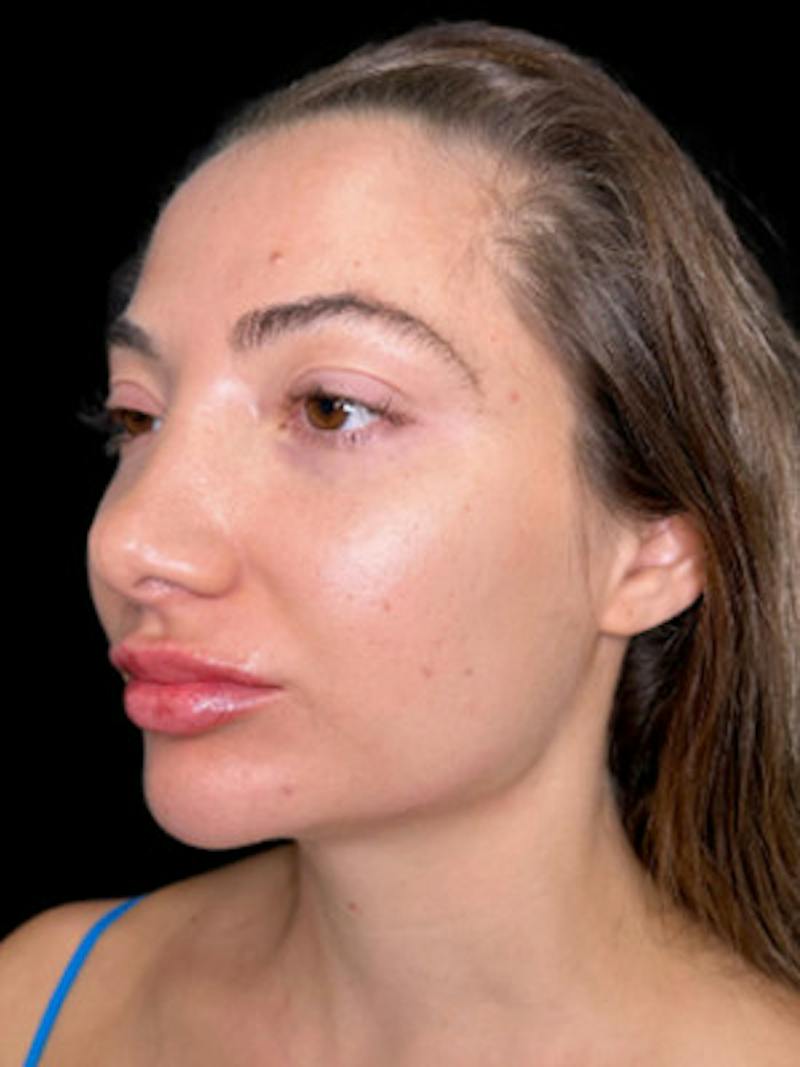 Filler Before & After Gallery - Patient 299646 - Image 4