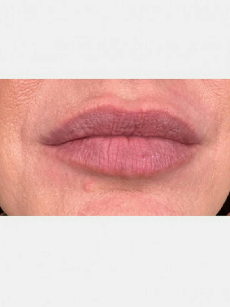 Filler Before & After Gallery - Patient 377531 - Image 1