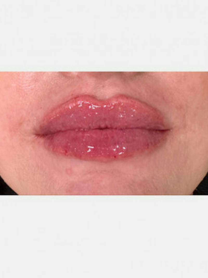 Filler Before & After Gallery - Patient 377531 - Image 2
