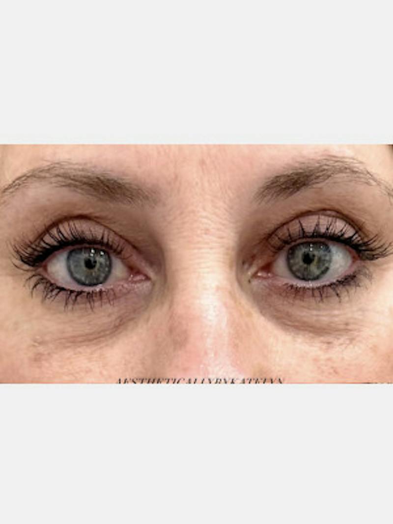 Filler Before & After Gallery - Patient 125873 - Image 1