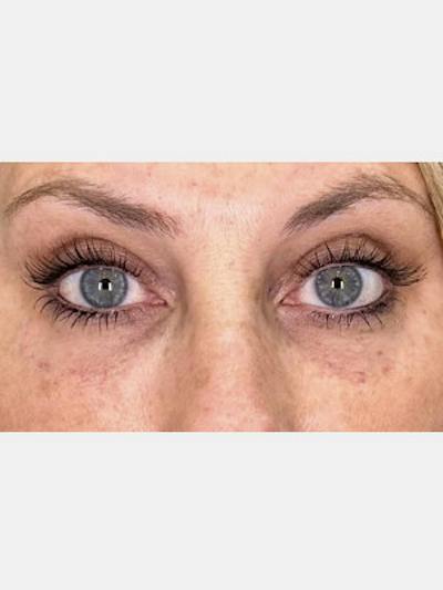 Filler Before & After Gallery - Patient 125873 - Image 2